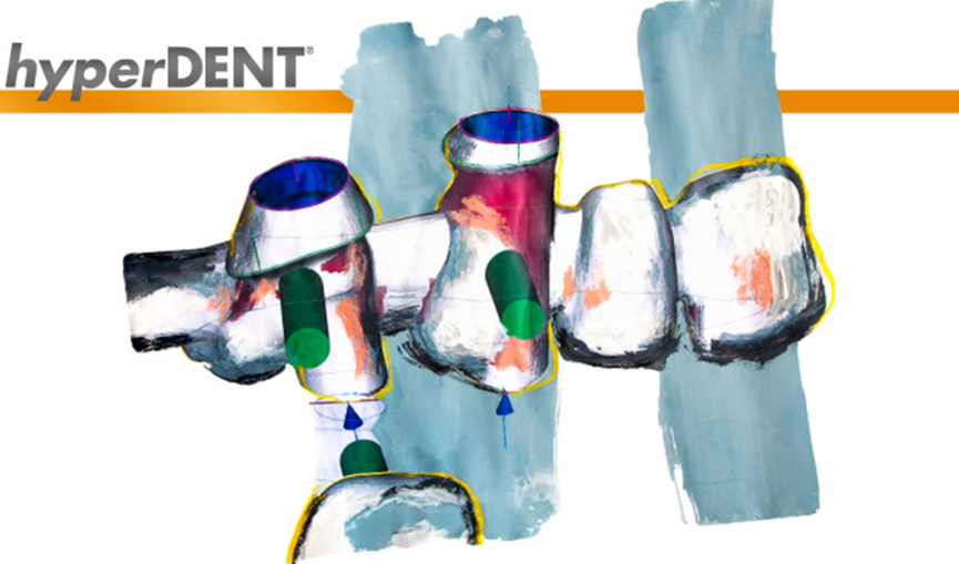 hyperDENT 5轴加工如何修整轮廓
