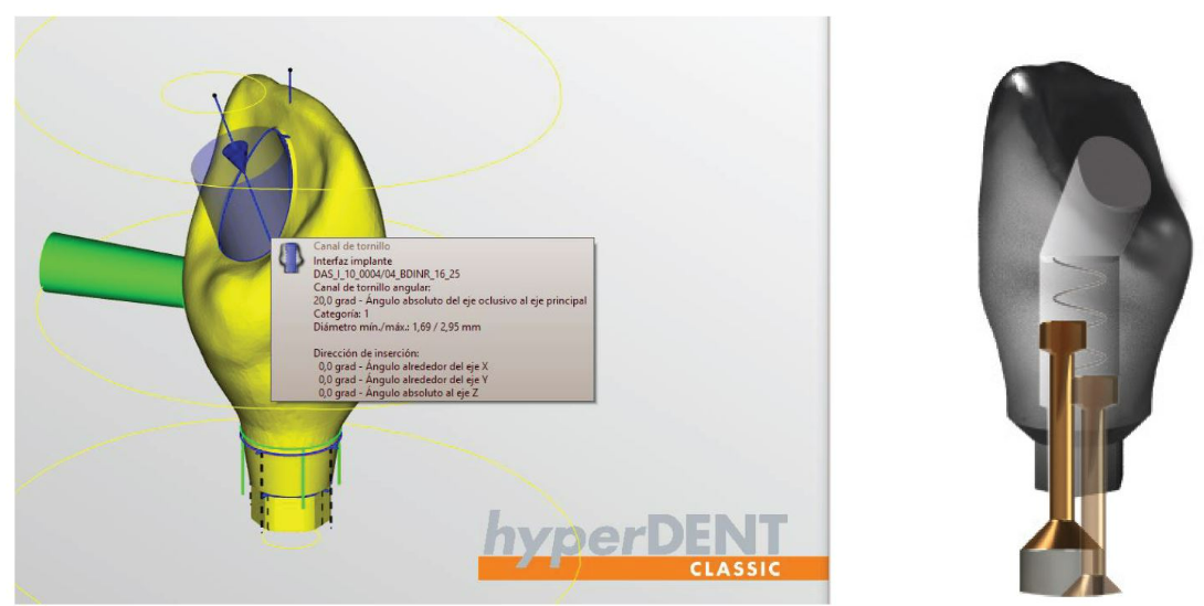 hyperDENT应该如何考虑修复体的清洁问题