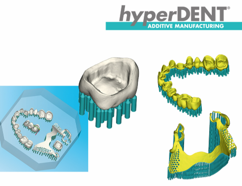 hyperDENT怎么确保修复体的平滑度